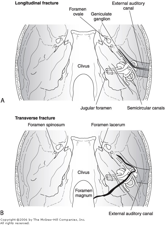Temporal Bone Fracture